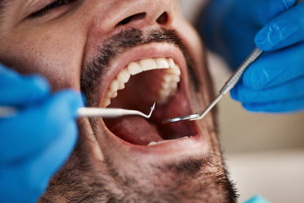 Best Emergency Wisdom Tooth Extraction in Lone Tree, IA